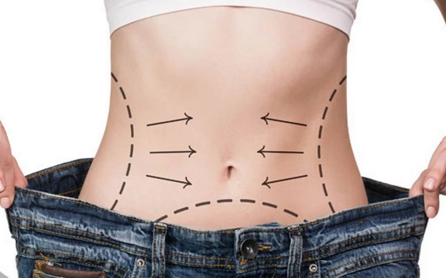 لیپوساکشن شکم و پهلو
