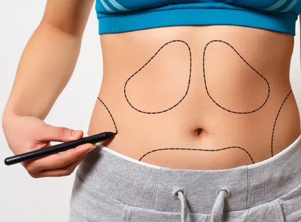 ابدومینوپلاستی در قم