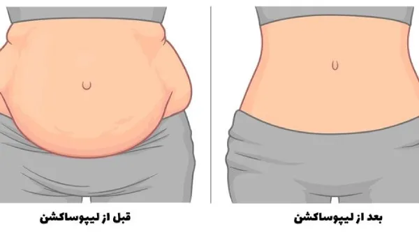قیمت عمل لیپوساکشن کمر