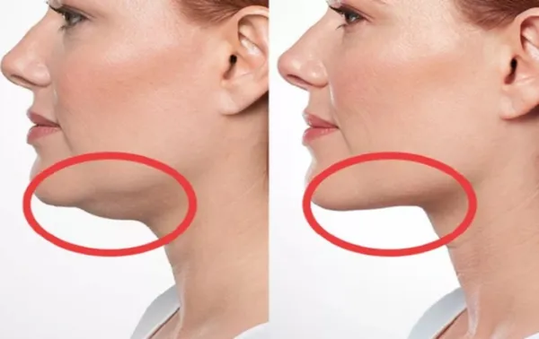 تفاوت دو تکنیک لیپوفیس و بوکال فت