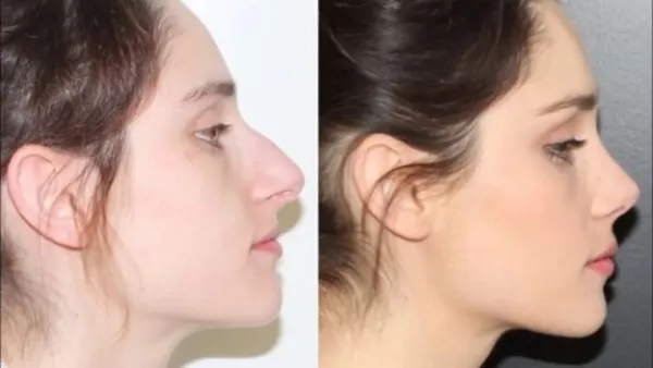 کوچک کردن بینی با جراحی