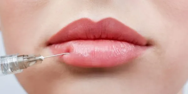 تزریق ژل لب مدل روسی