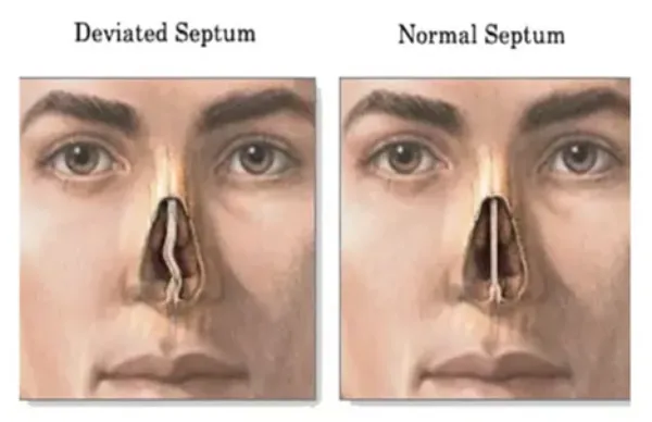 سپتوپلاستی چیست