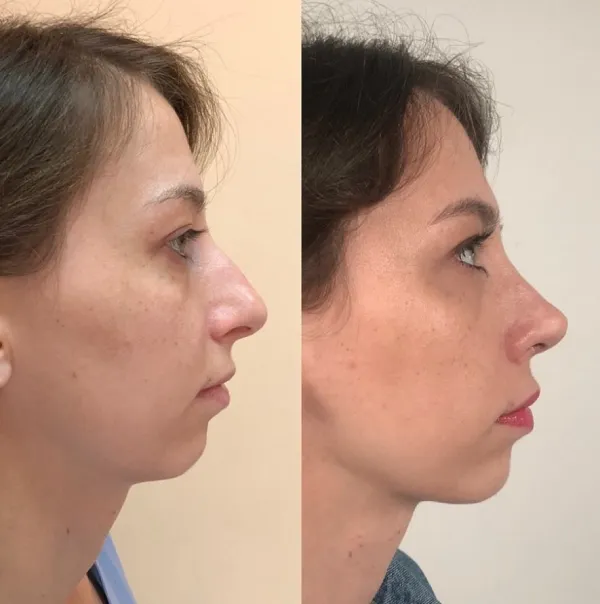 جراحی سپتوپلاستی