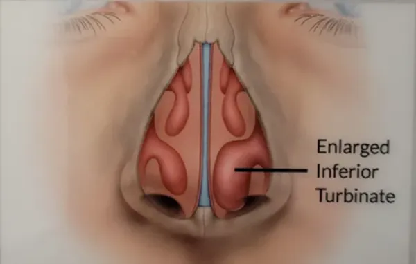 عمل كوچك كردن پره های بينی