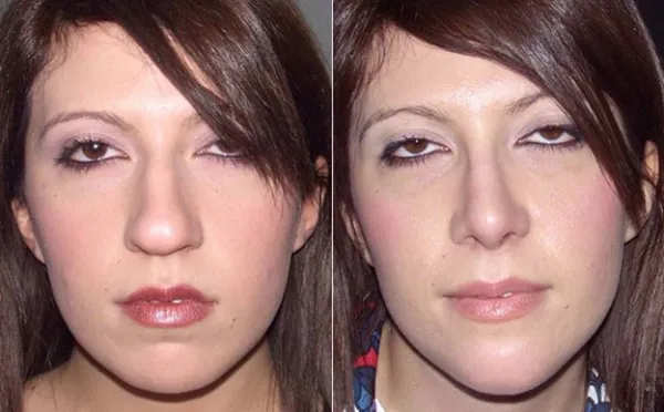 آلارپلاستی چیست