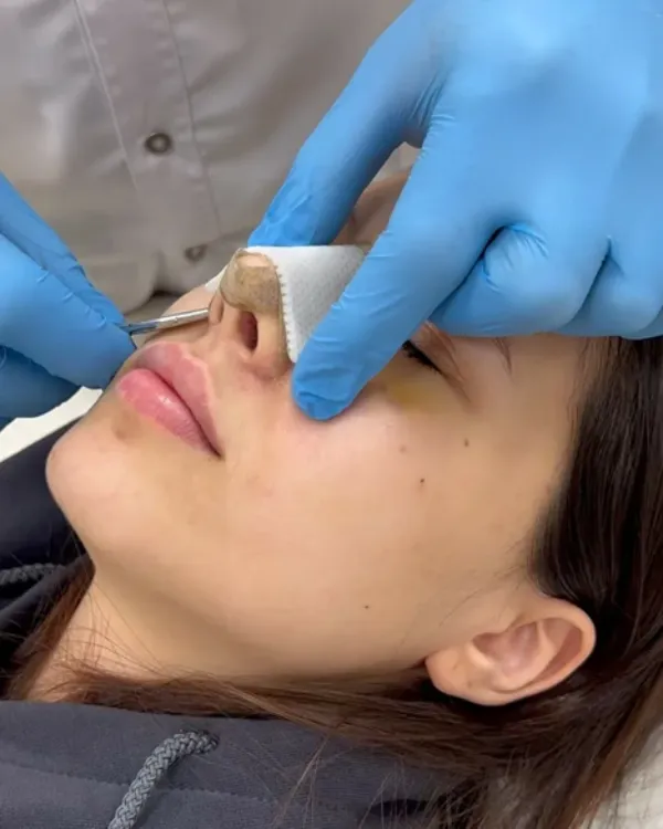 عوارض عمل بینی به روش بسته