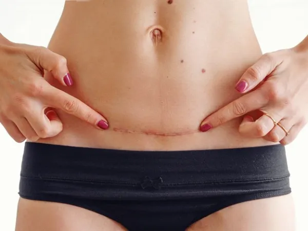 جای بخیه ابدومینوپلاستی