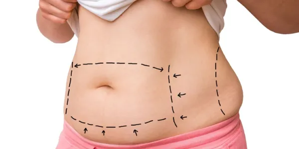 مینی ابدومینوپلاستی