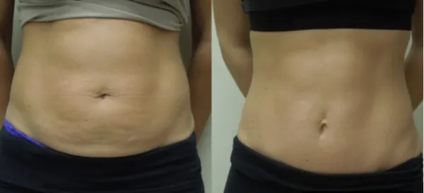 عمل مینی ابدو چیست