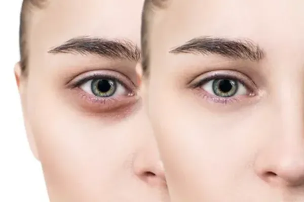 تزریق چربی زیر چشم