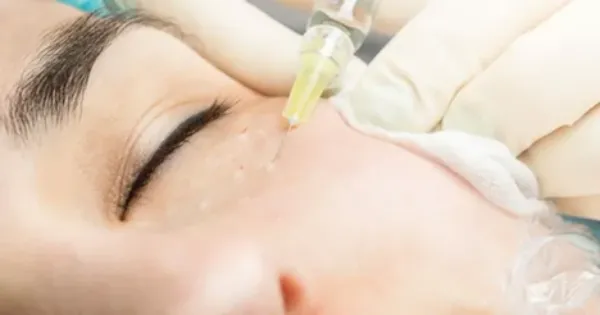 تزریق چربی به گودی زیر چشم
