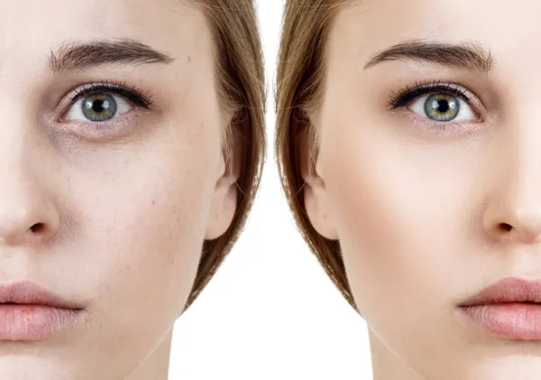برای زیر چشم تزریق چربی بهتره یا فیلر