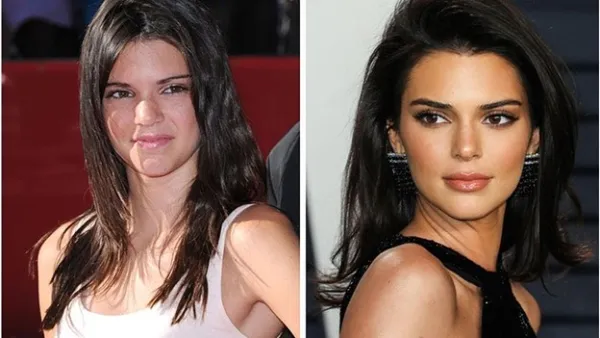 عمل زیبایی چشم