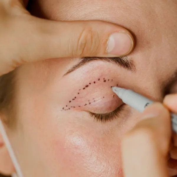 جراحی زیبایی چشم